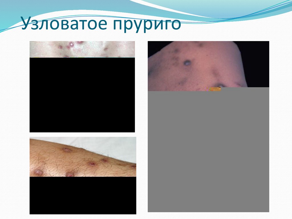 Узловатое пруриго