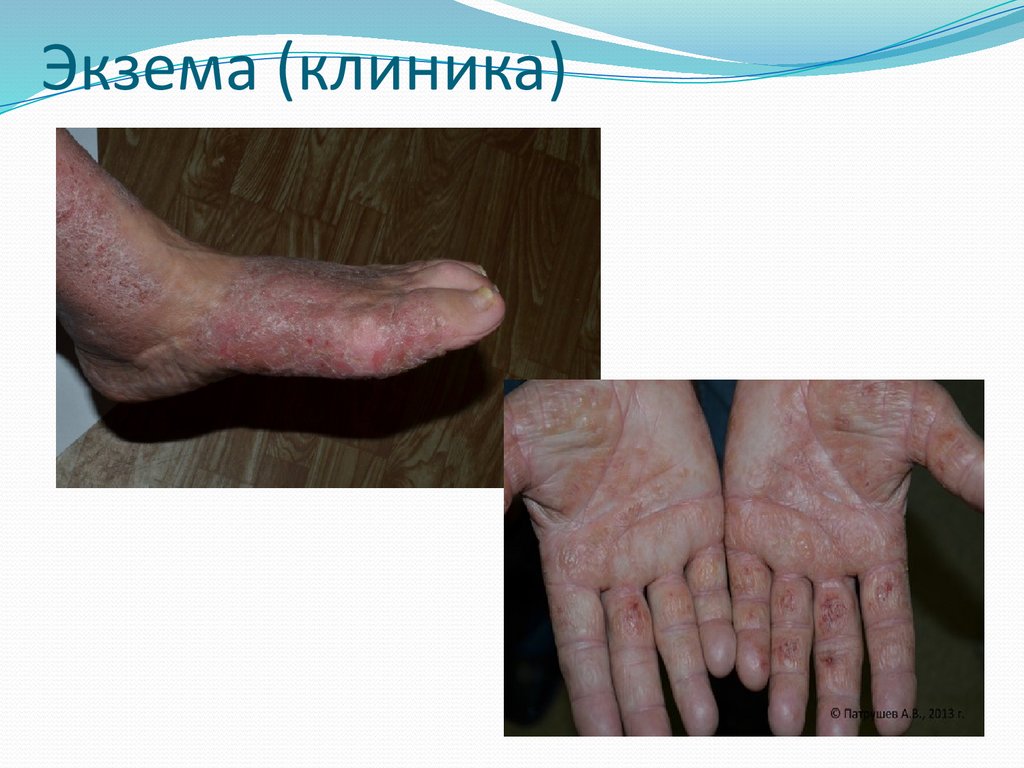 Экзема (клиника)