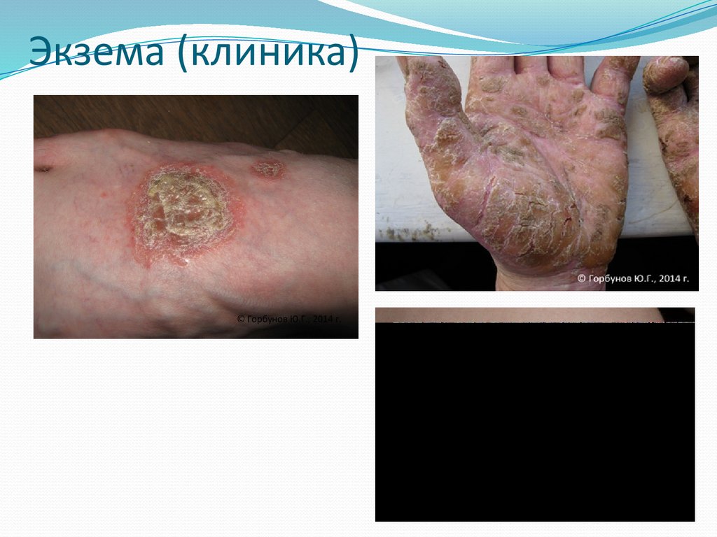 Экзема (клиника)