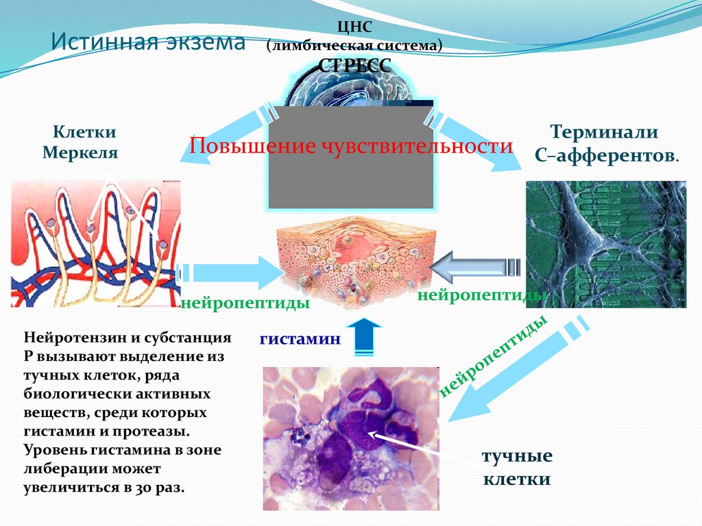 Истинная экзема