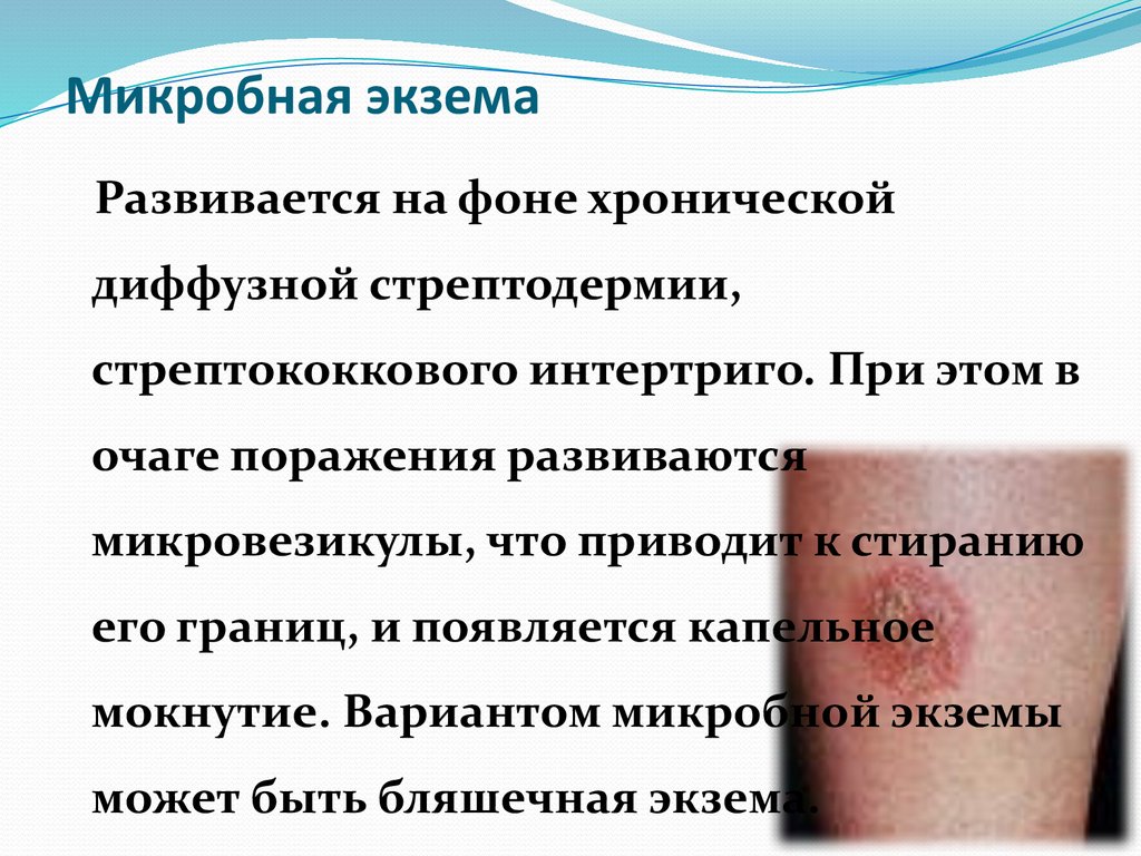 Микробная экзема
