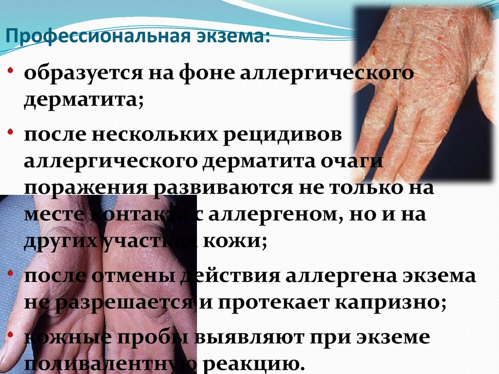 Профессиональная экзема: