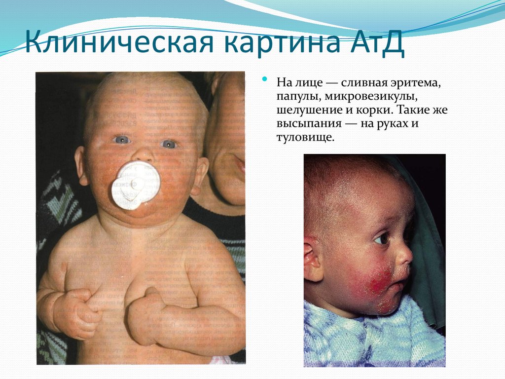 Клиническая картина АтД