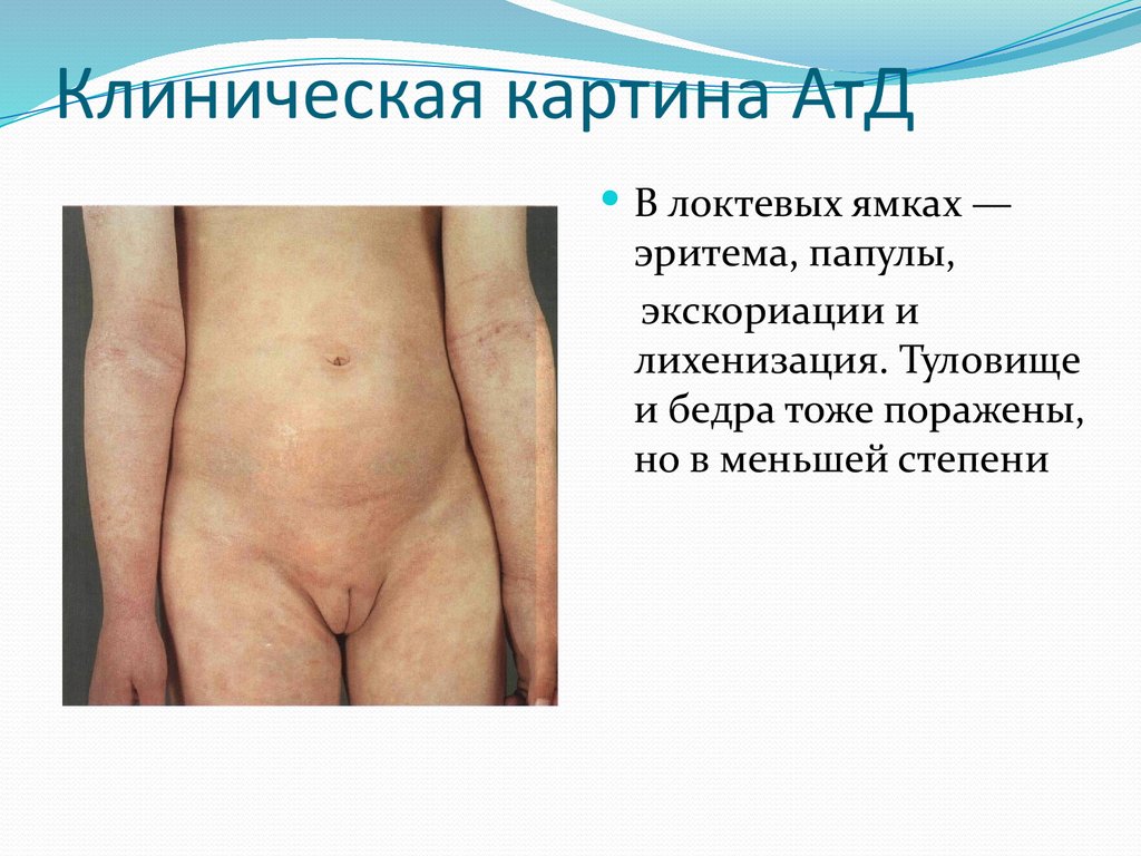 Клиническая картина АтД