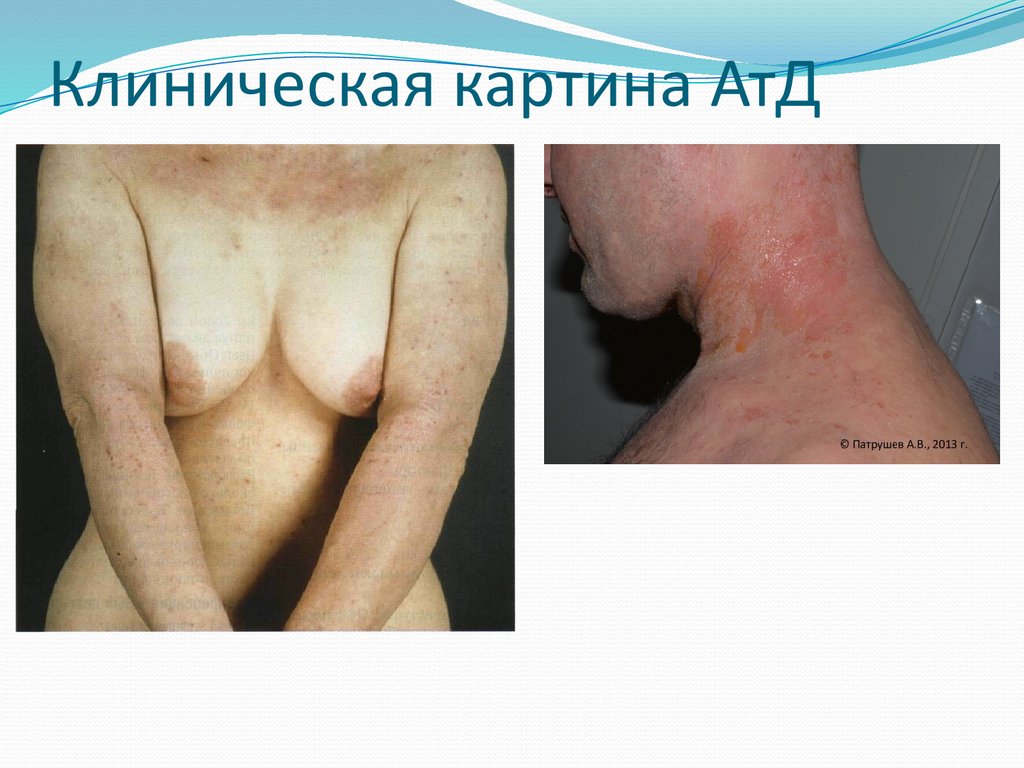 Клиническая картина АтД