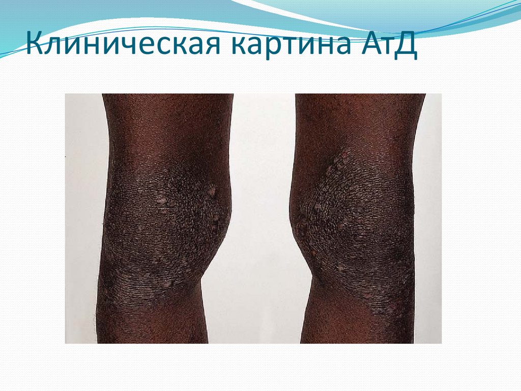 Клиническая картина АтД