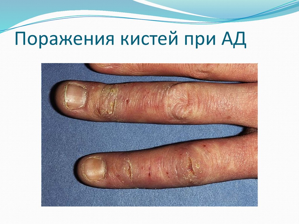Поражения кистей при АД