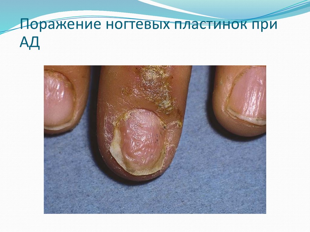 Поражение ногтевых пластинок при АД