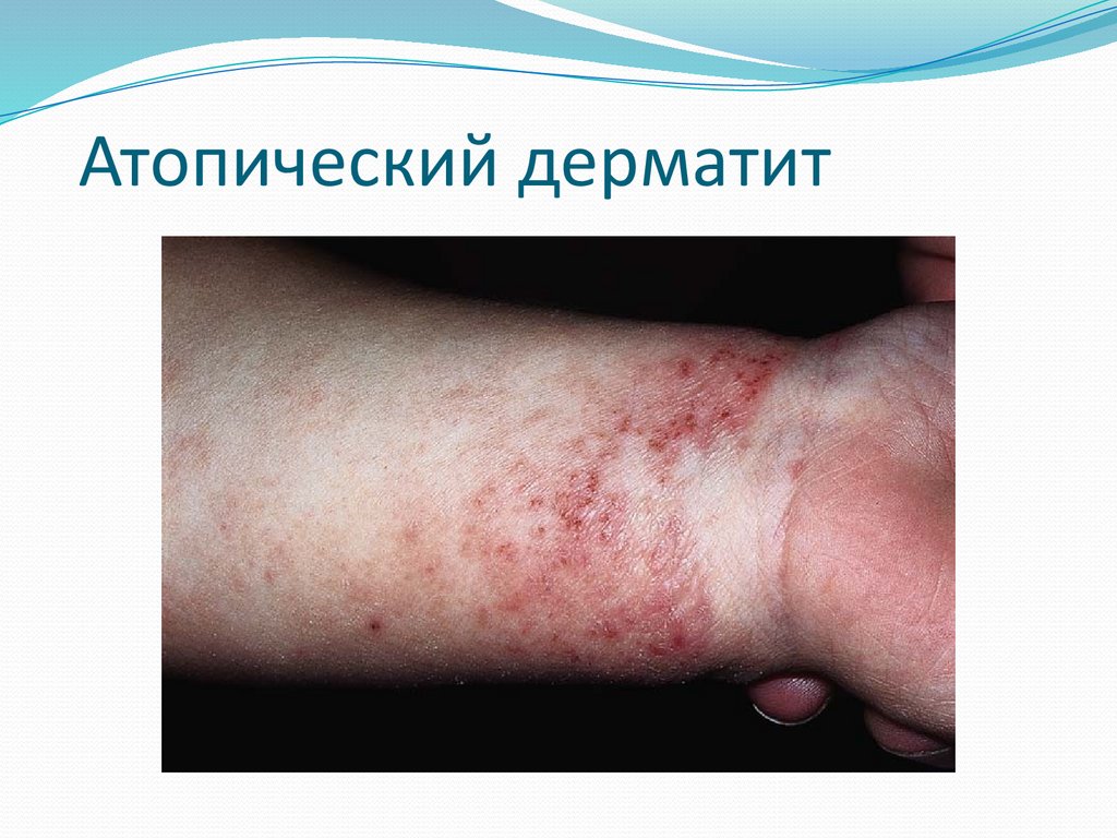 Атопический дерматит