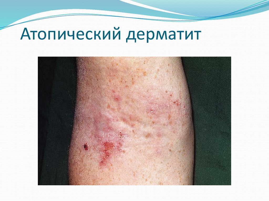 Атопический дерматит