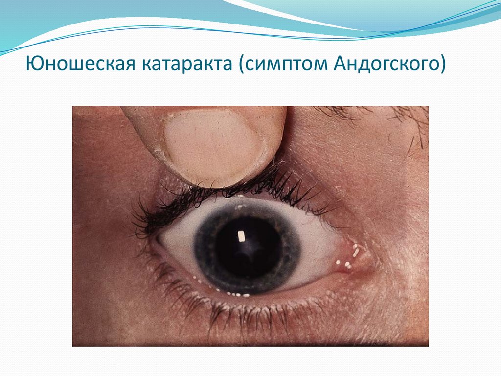 Юношеская катаракта (симптом Андогского)