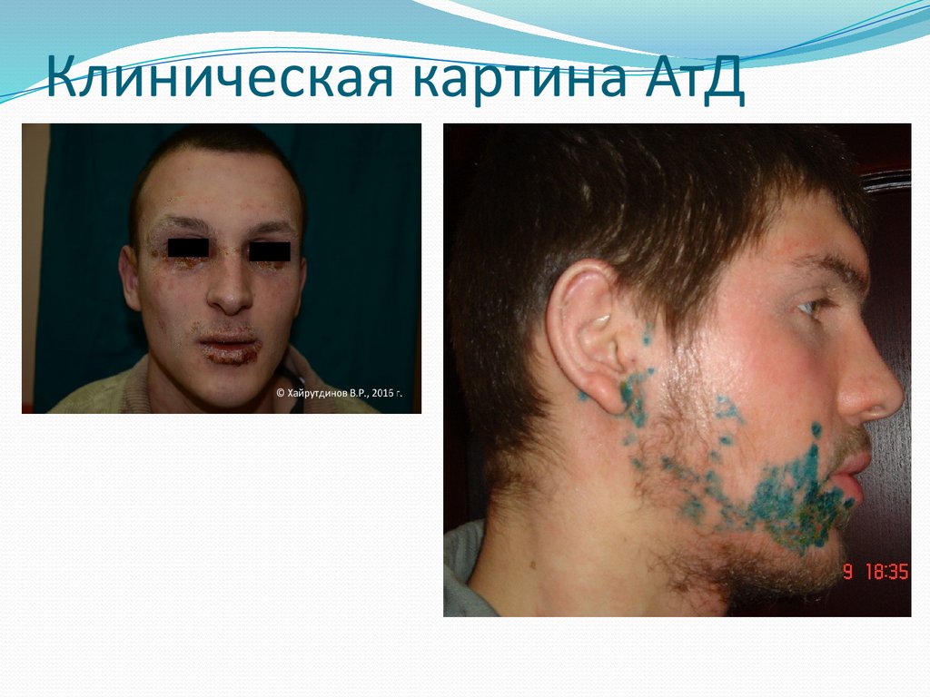 Клиническая картина АтД