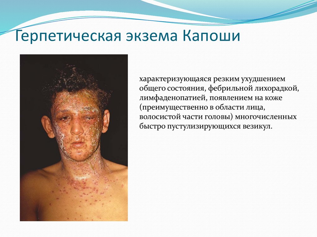 Герпетическая экзема Капоши