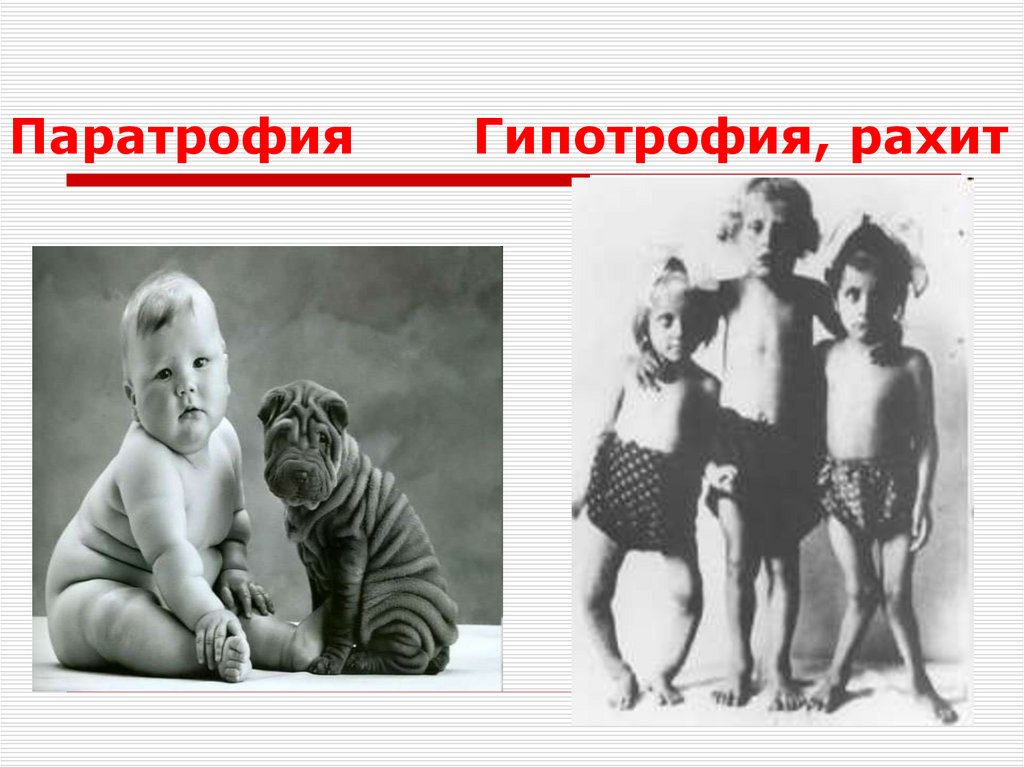 Паратрофия Гипотрофия, рахит