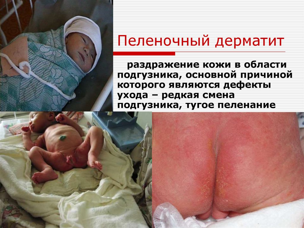 Пеленочный дерматит