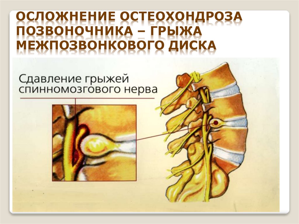 Осложнение остеохондроза позвоночника – грыжа межпозвонкового диска