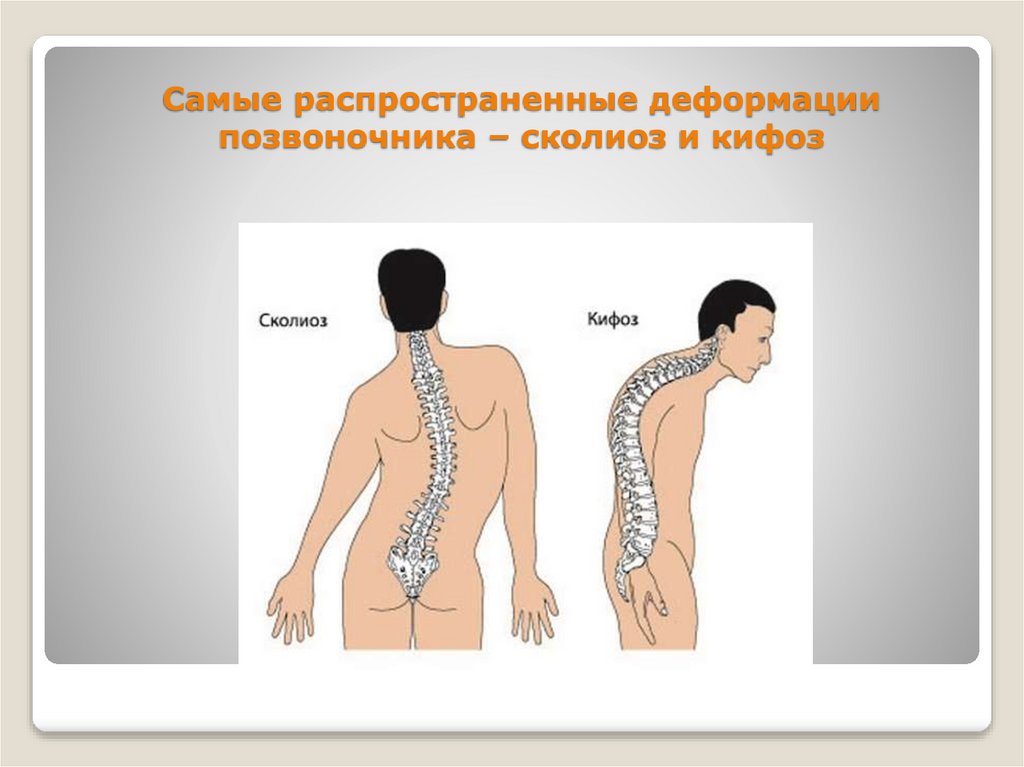 Самые распространенные деформации позвоночника – сколиоз и кифоз