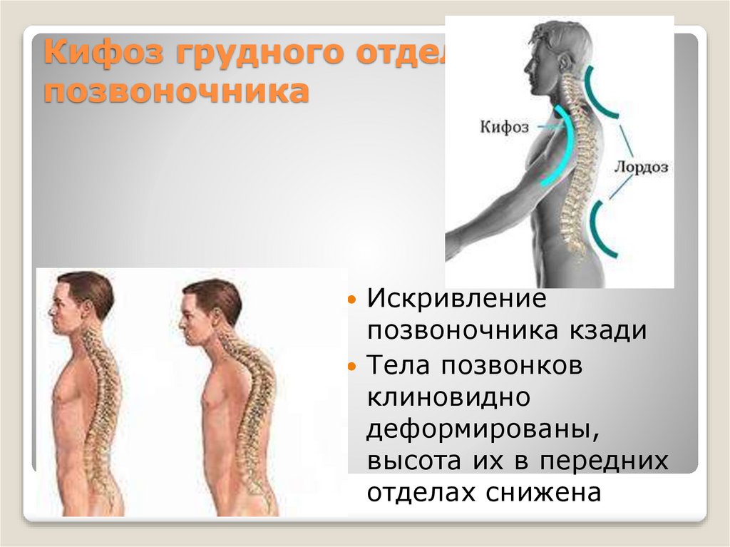 Кифоз грудного отдела позвоночника