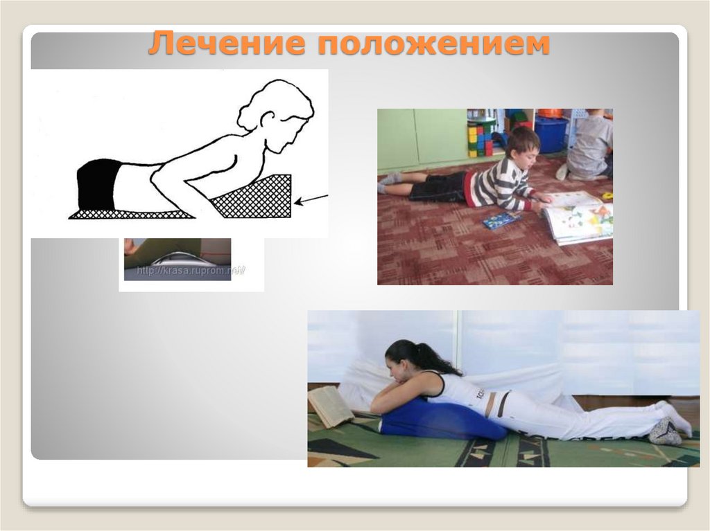 Лечение положением