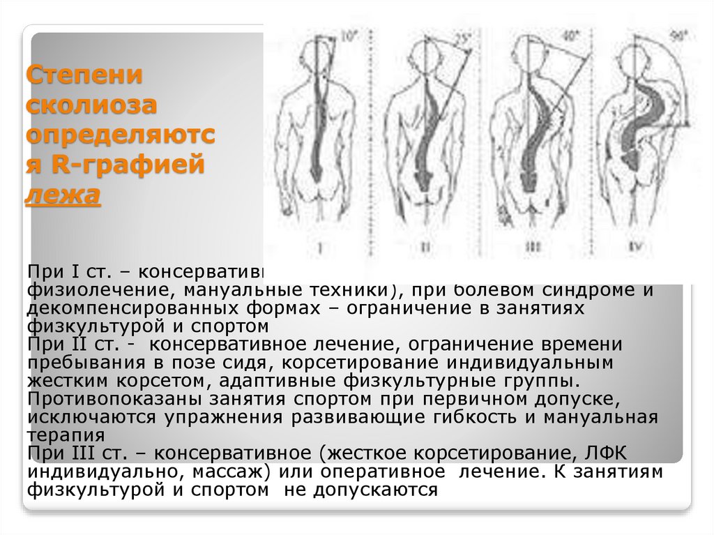 Степени сколиоза определяются R-графией лежа