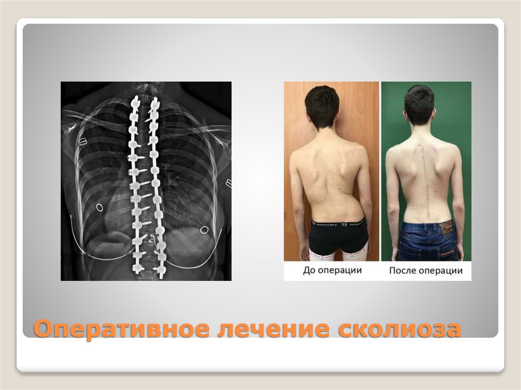 Оперативное лечение сколиоза