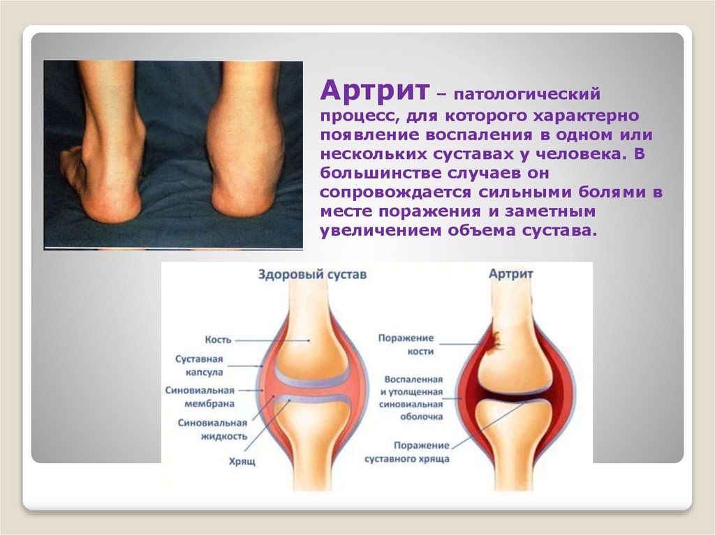 Артрит – патологический процесс, для которого характерно появление воспаления в одном или нескольких суставах у человека. В