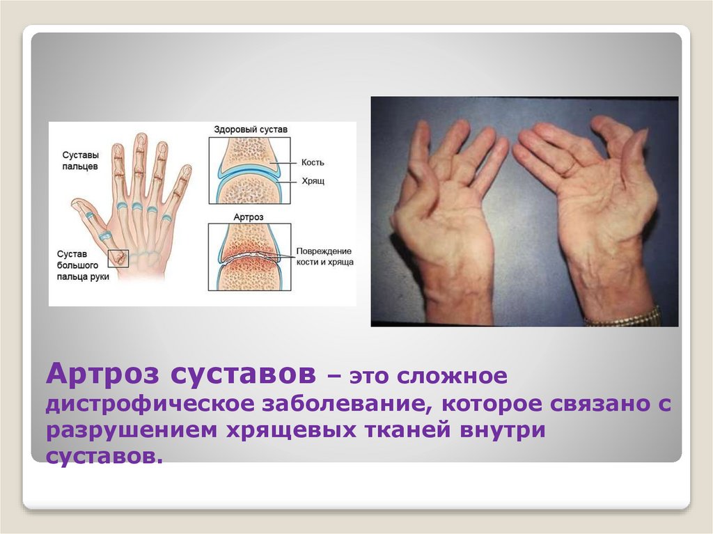Артроз суставов – это сложное дистрофическое заболевание, которое связано с разрушением хрящевых тканей внутри суставов.