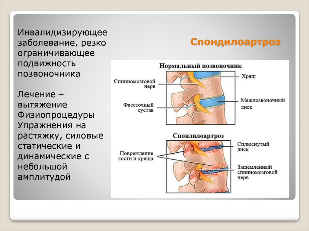 Спондилоартроз