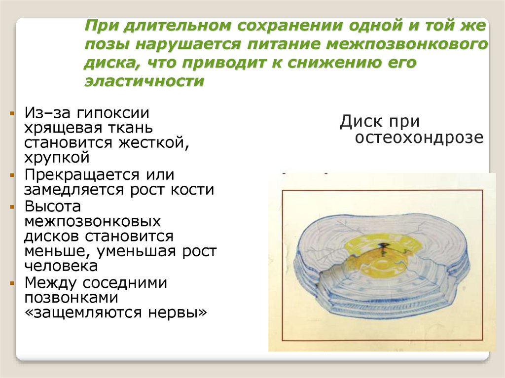 При длительном сохранении одной и той же позы нарушается питание межпозвонкового диска, что приводит к снижению его