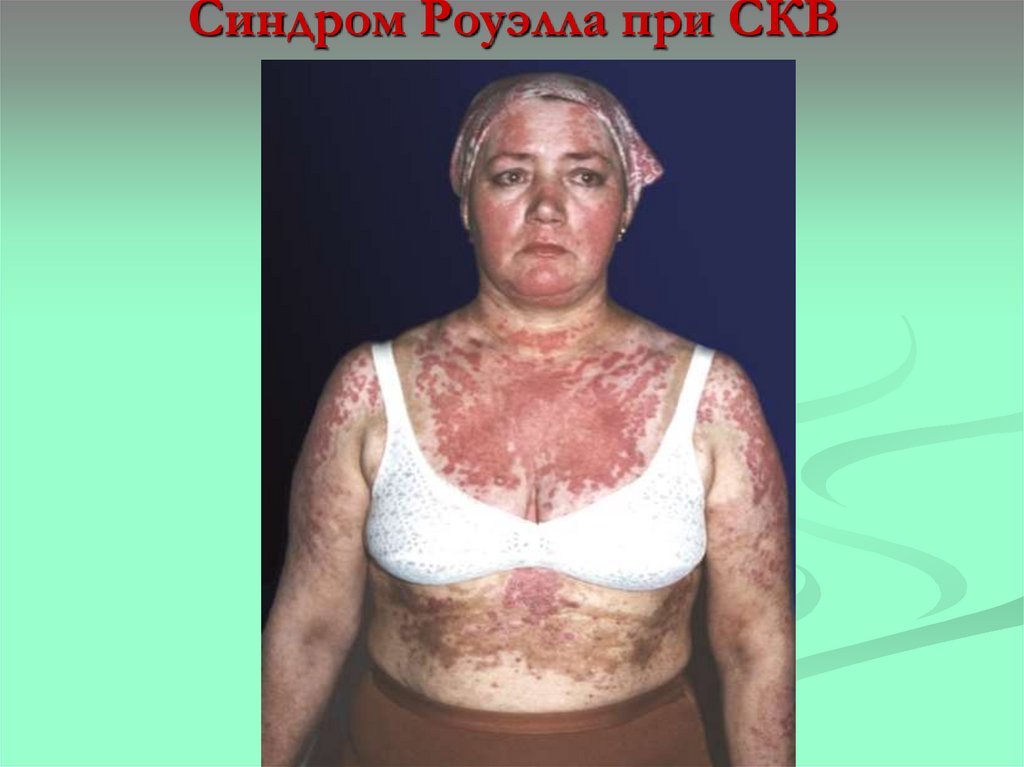 Синдром Роуэлла при СКВ