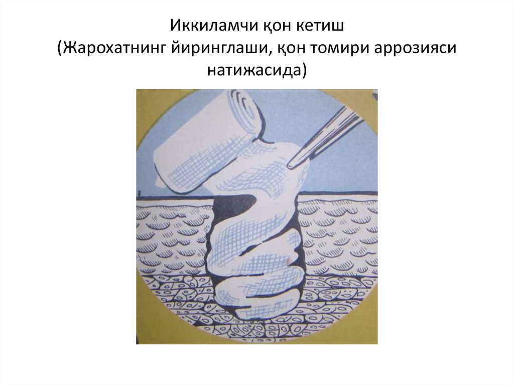 Иккиламчи қон кетиш (Жарохатнинг йиринглаши, қон томири аррозияси натижасида)