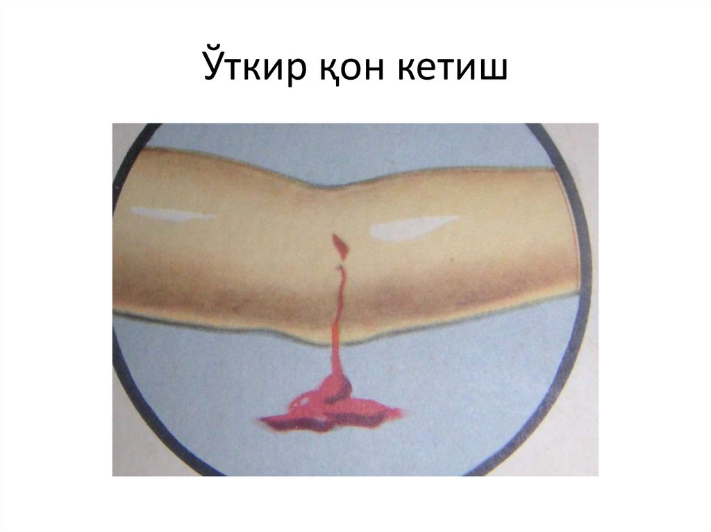 Ўткир қон кетиш