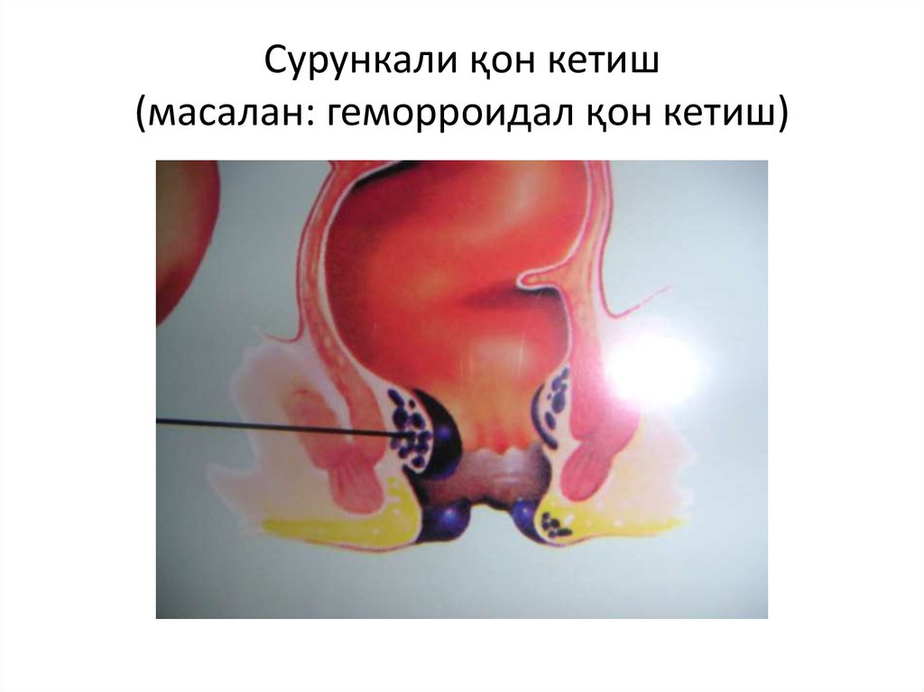 Сурункали қон кетиш (масалан: геморроидал қон кетиш)