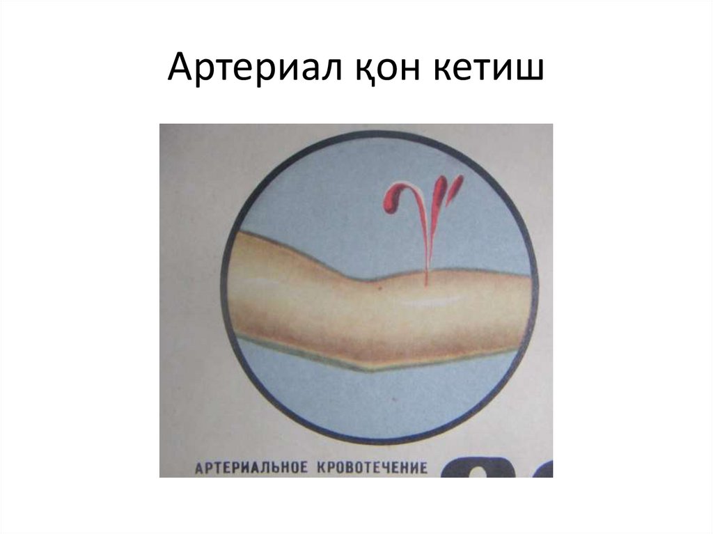 Артериал қон кетиш