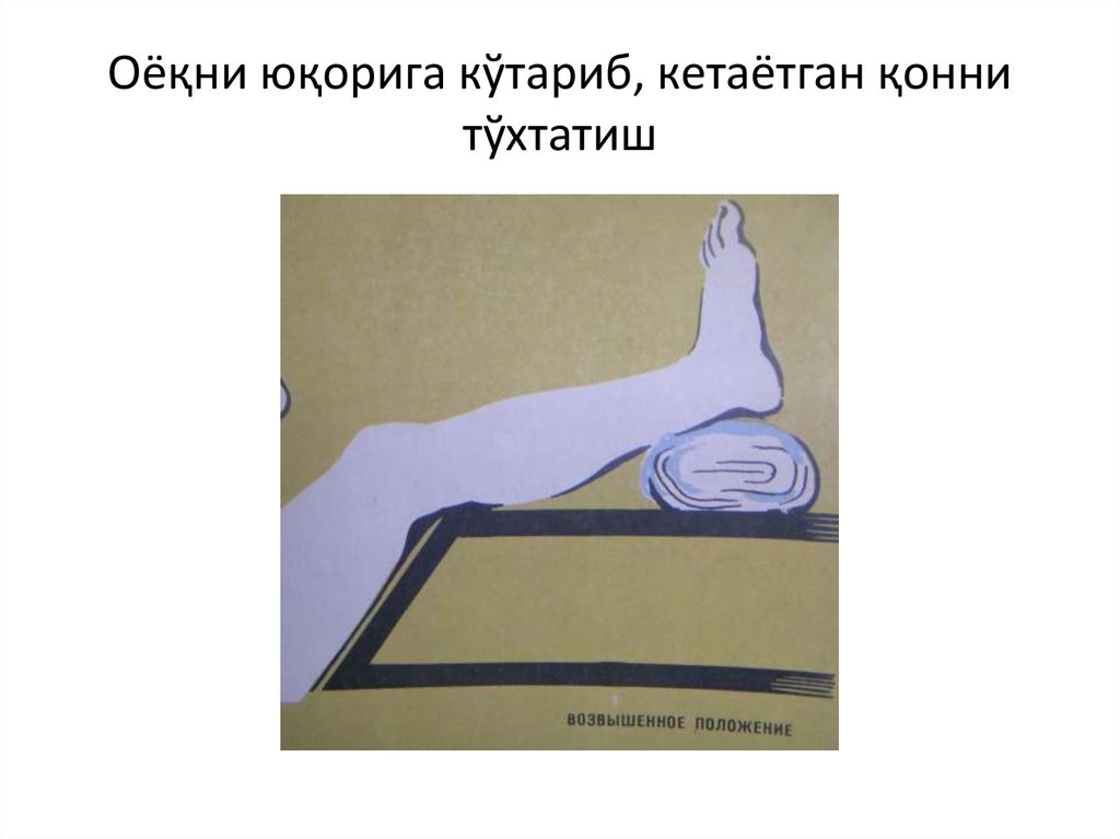 Оёқни юқорига кўтариб, кетаётган қонни тўхтатиш