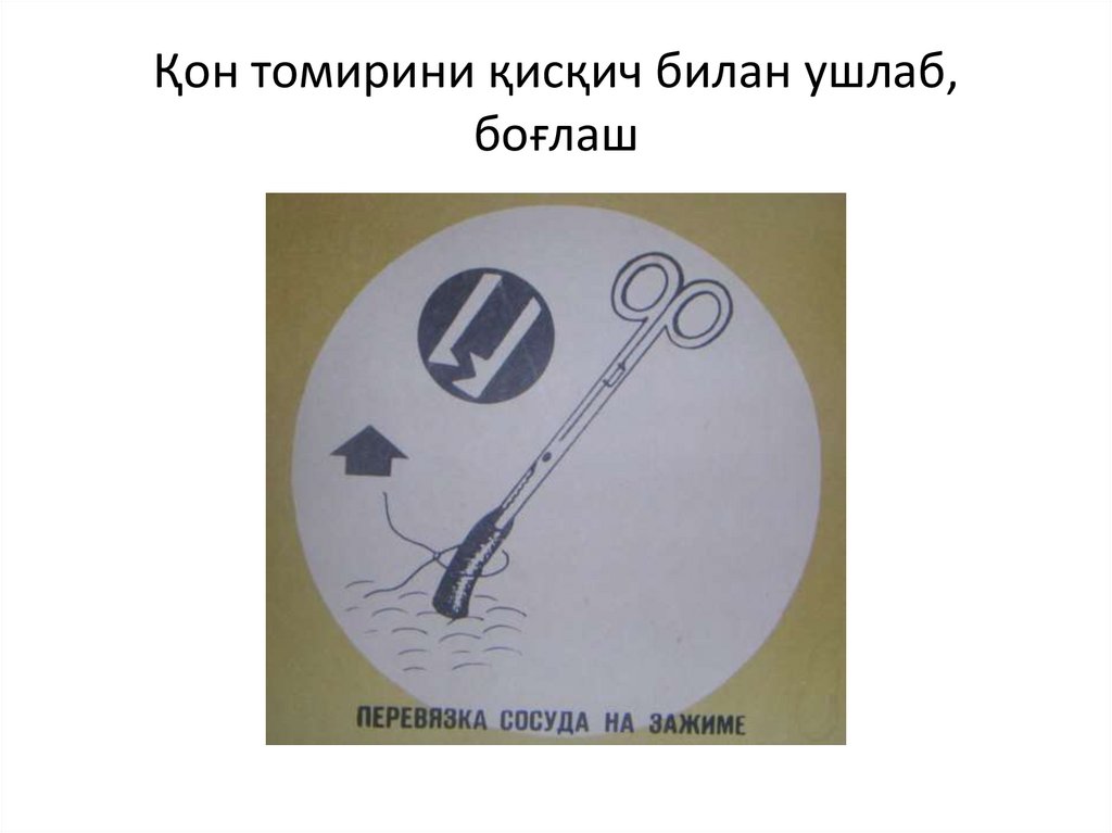 Қон томирини қисқич билан ушлаб, боғлаш