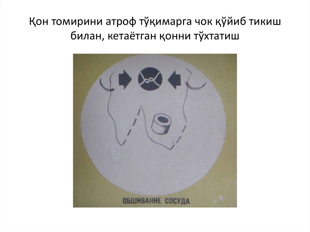 Қон томирини атроф тўқимарга чок қўйиб тикиш билан, кетаётган қонни тўхтатиш