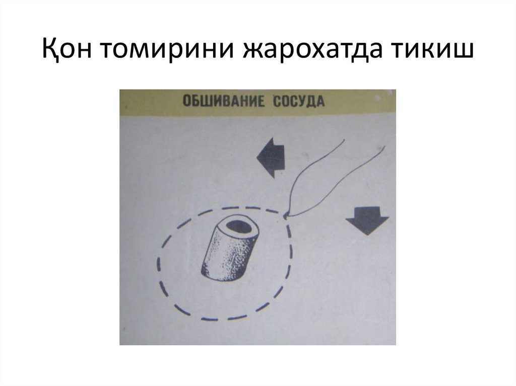 Қон томирини жарохатда тикиш