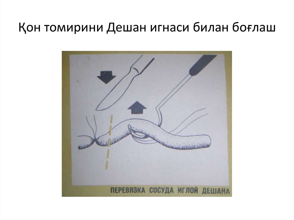 Қон томирини Дешан игнаси билан боғлаш