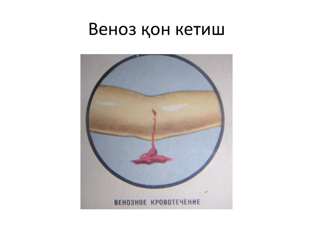 Веноз қон кетиш