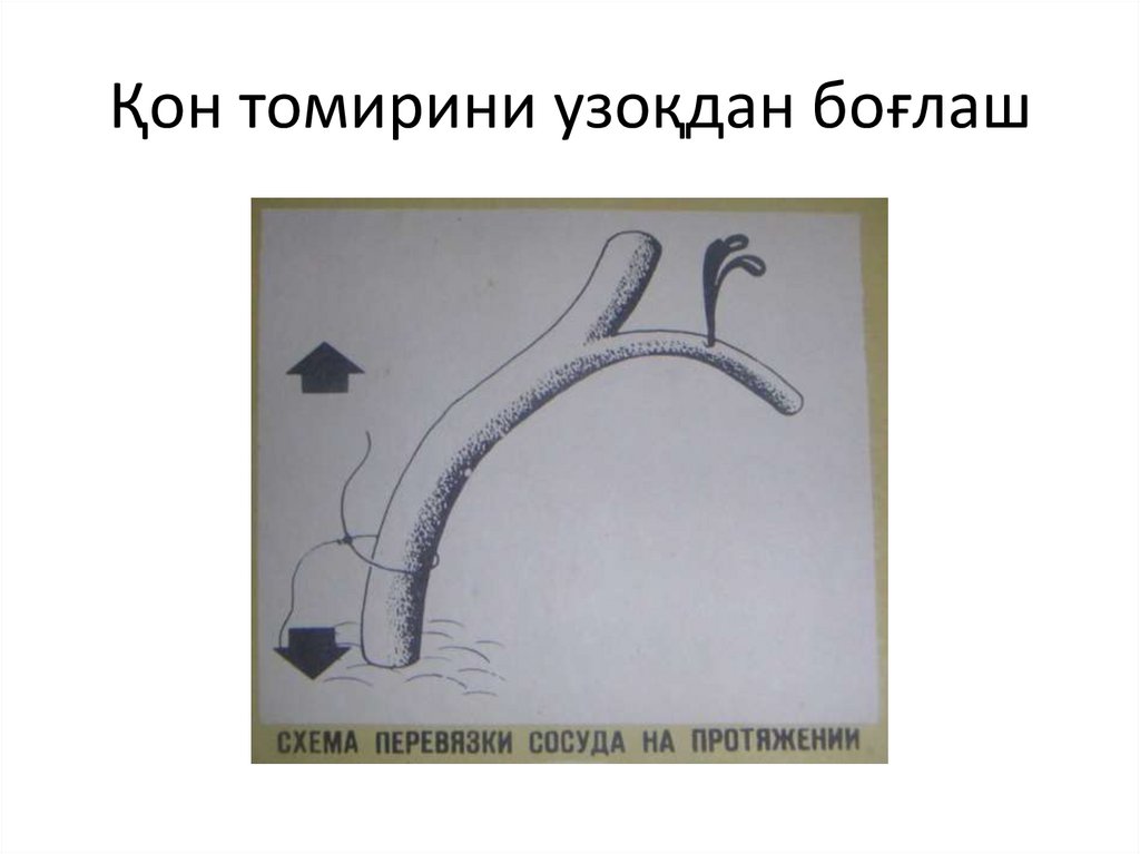 Қон томирини узоқдан боғлаш