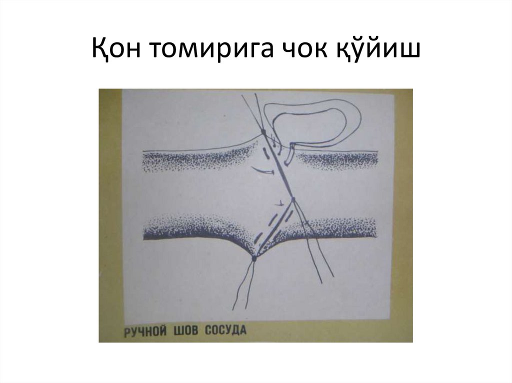 Қон томирига чок қўйиш