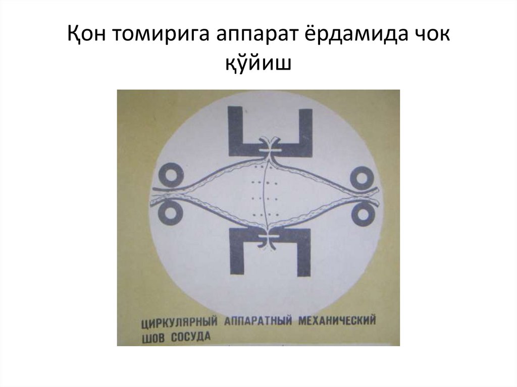 Қон томирига аппарат ёрдамида чок қўйиш