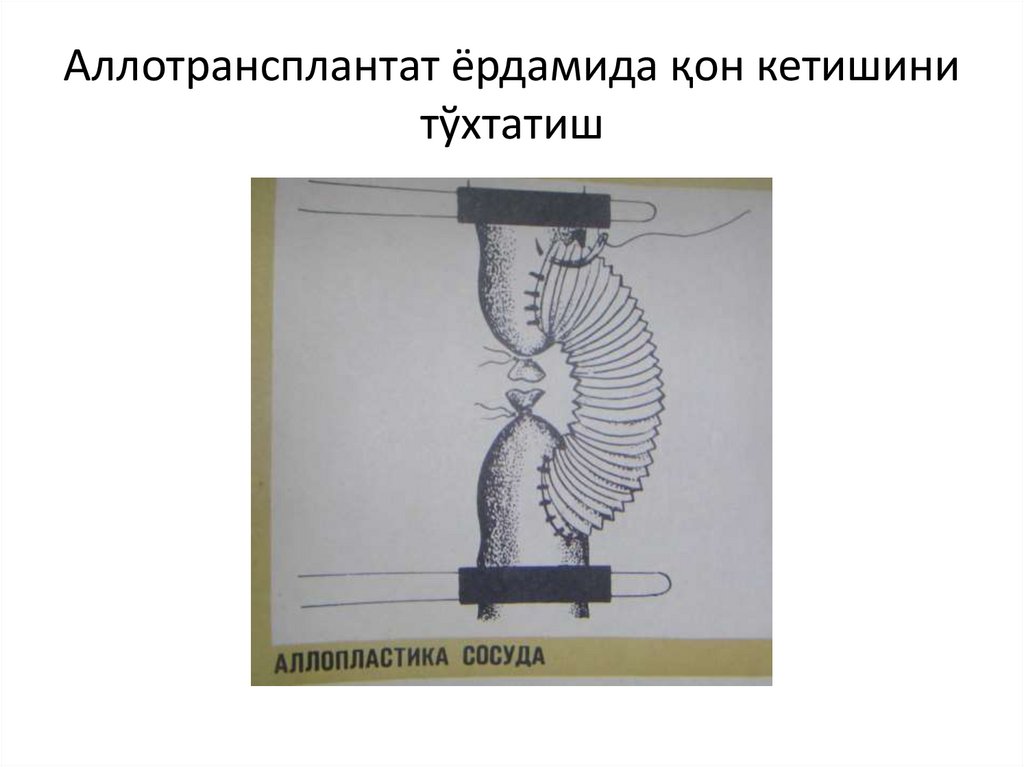 Аллотрансплантат ёрдамида қон кетишини тўхтатиш