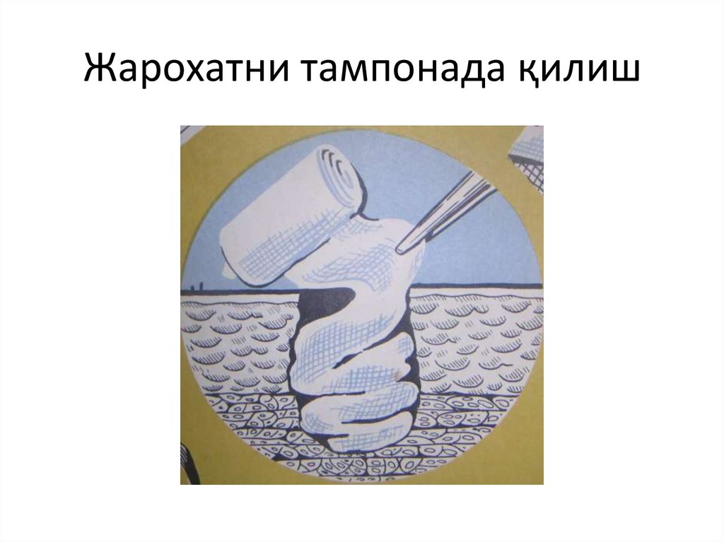 Жарохатни тампонада қилиш