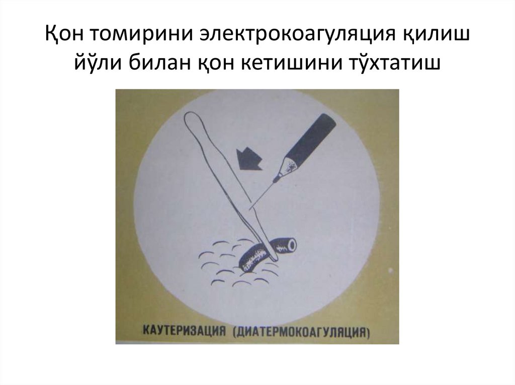 Қон томирини электрокоагуляция қилиш йўли билан қон кетишини тўхтатиш