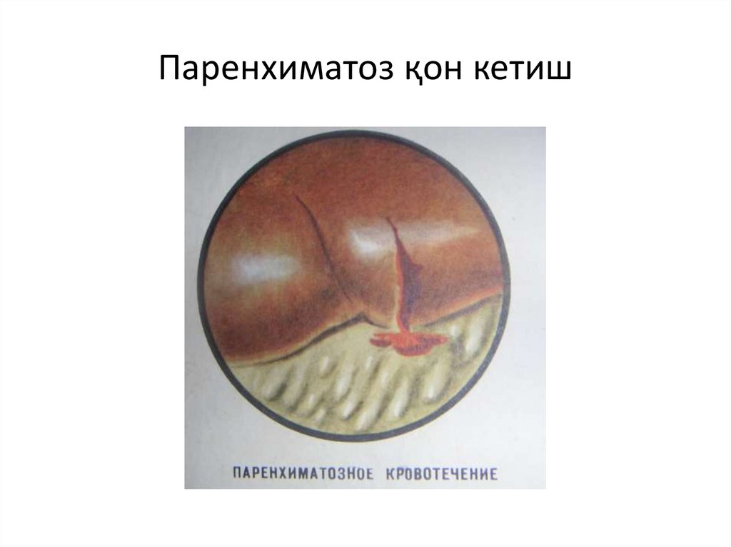 Паренхиматоз қон кетиш