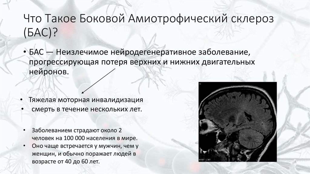 Что Такое Боковой Амиотрофический склероз (БАС)?