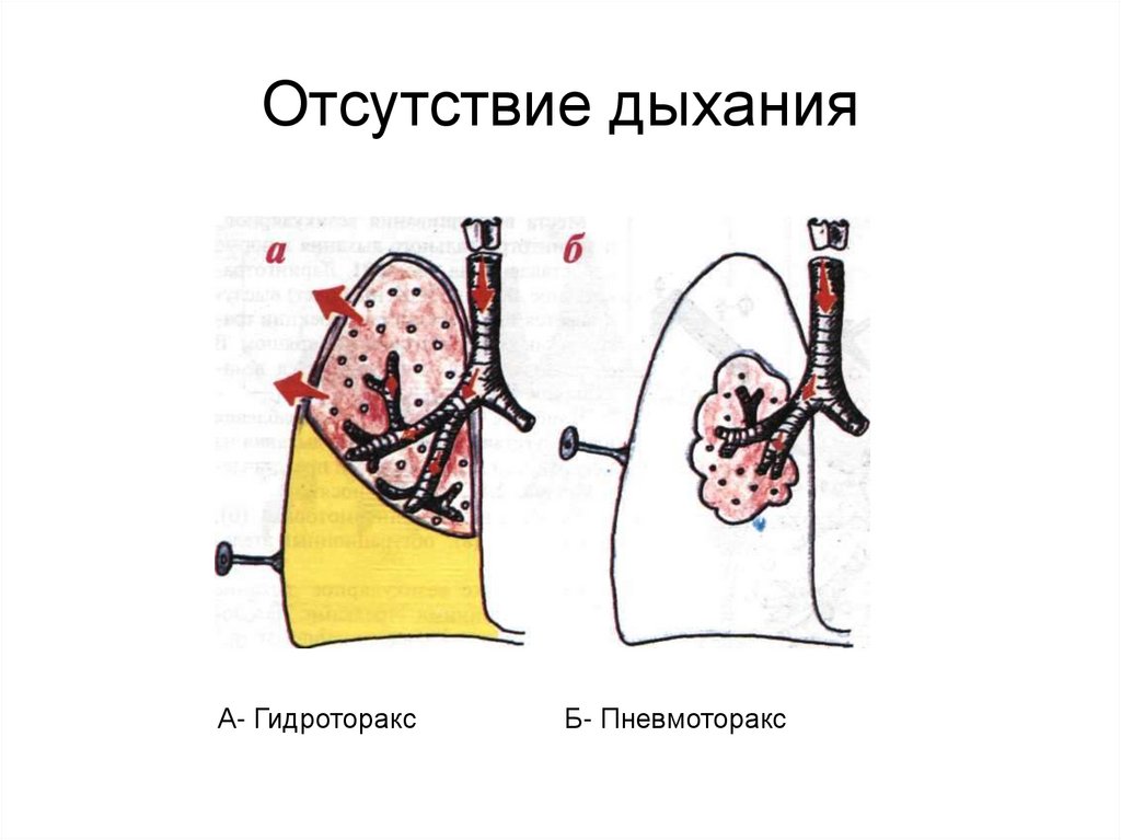 Отсутствие дыхания