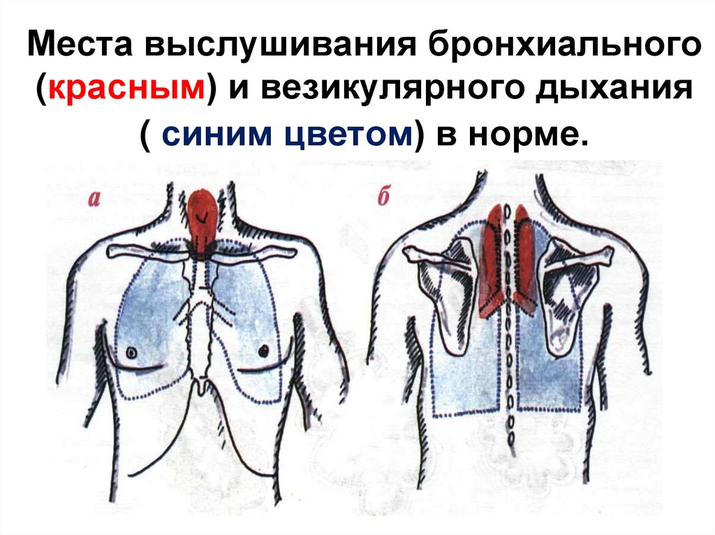 Места выслушивания бронхиального (красным) и везикулярного дыхания ( синим цветом) в норме.